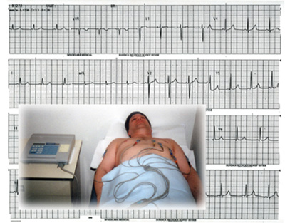 EKG nedir?