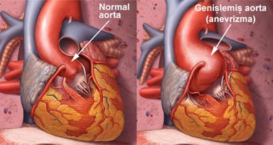 Aort Anevrizması