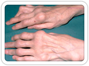 Artrit (Romatoid Artrit)