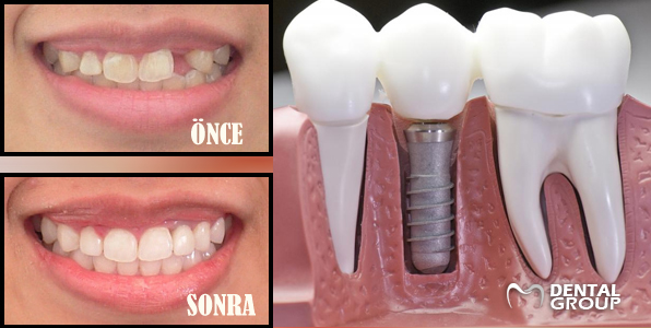 Dental İmplantlar Diş Ekimi