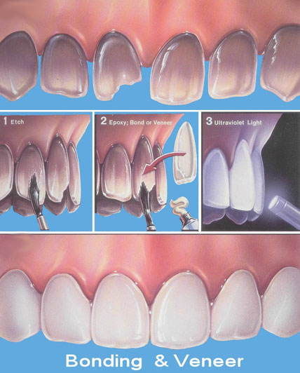 Adeziv Sistem (Bonding) Nedir?