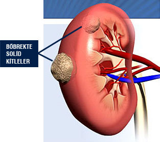 Böbrek Tümörü