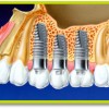 Dental İmplantlar Diş Ekimi