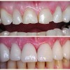 Porselen Laminate Kaplamalar (Dental Veneers)