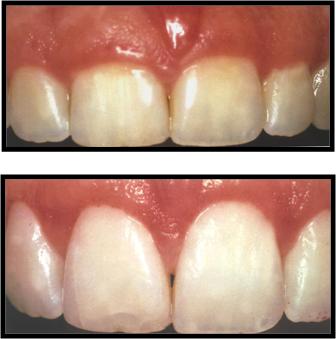 Sağlıklı Dişeti Ve Periodontal Dokular