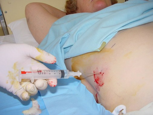 Karaciğer Biyopsisi