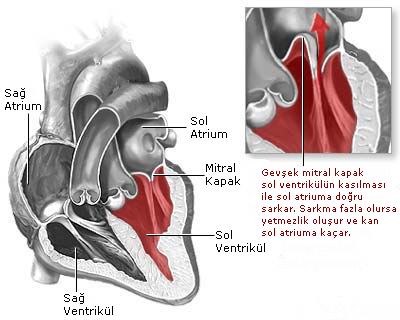 Mitral kapak yetmezliği