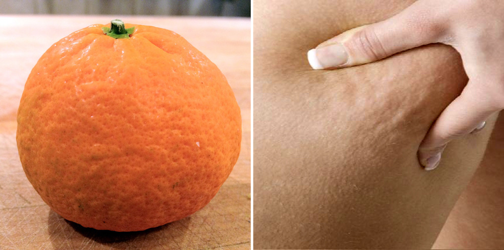 Ah şu selülit yağları…