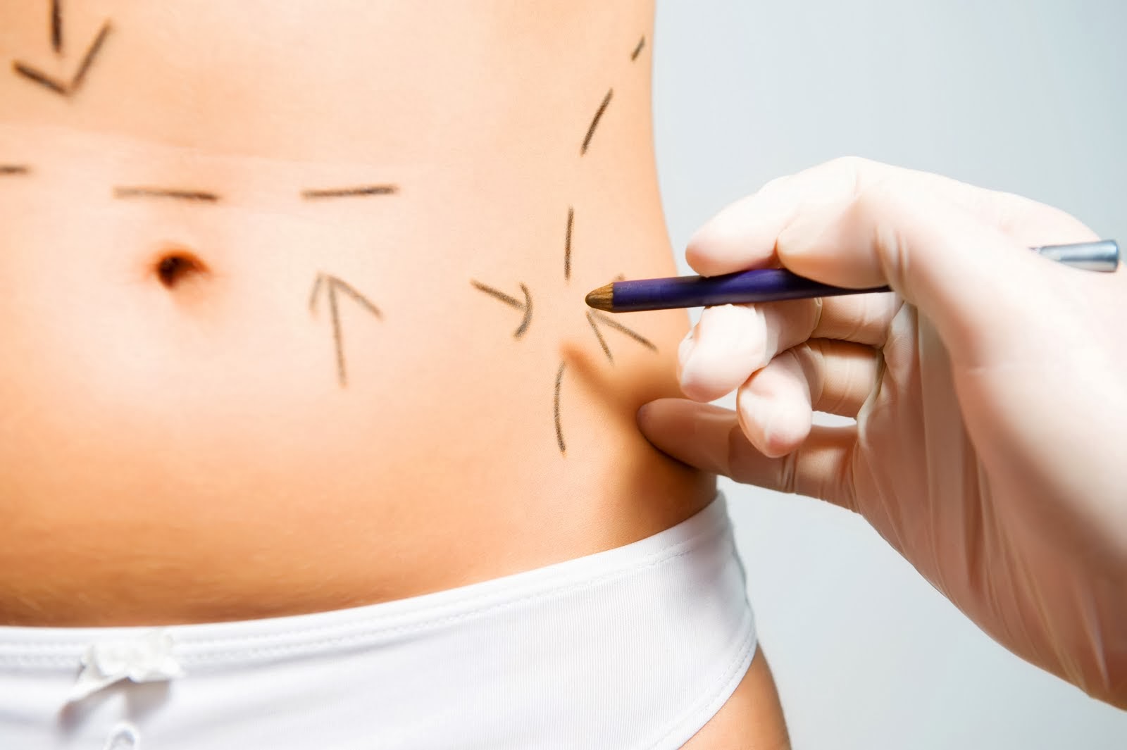 Liposuction