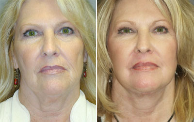 Silhouette Lift Yöntemi İle Kısa Sürede Yüz Germe