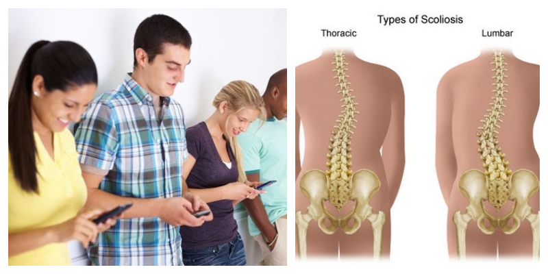 Akıllı Telefonlar Omurga Eğriliğine Neden Oluyor.