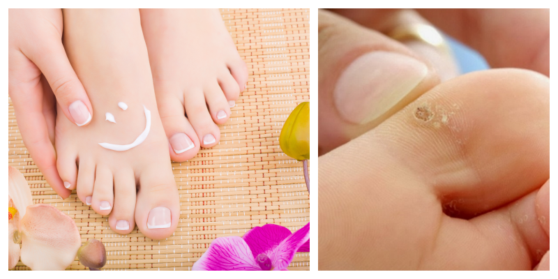 Ayak Mantarına Bitkisel Kürler