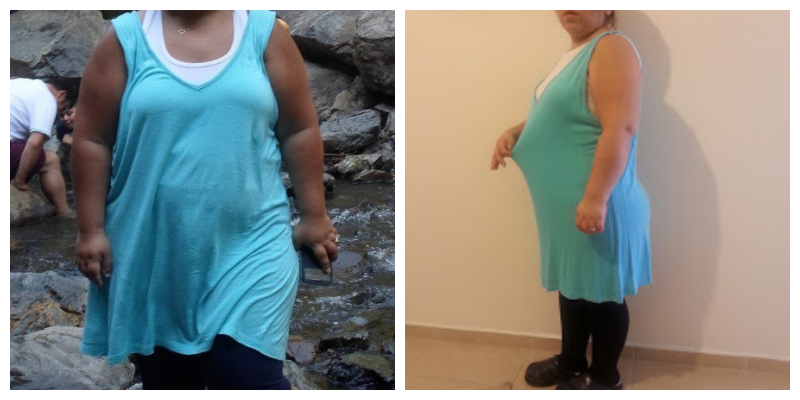 Obez Değil Lipödem Hastası Olduğunu Öğrendi