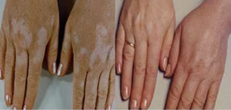 Deride Renk Açılması