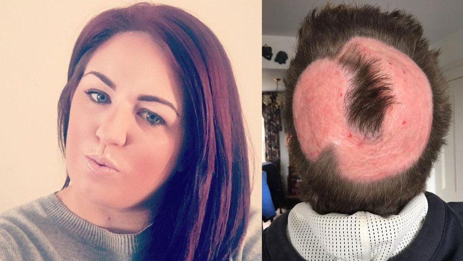 Saçlarını boyamak için aldığı açıcı yüzünden kel kaldı! Kadın herkesi uyarıyor