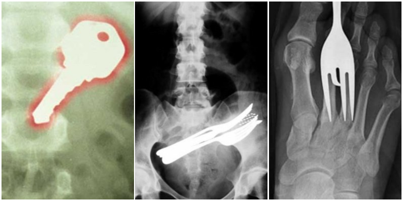 DÜNYANIN EN KORKUNÇ RÖNTGEN GÖRÜNTÜLERİ