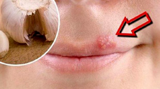 Bir gecede uçukları iz kalmadan geçirin