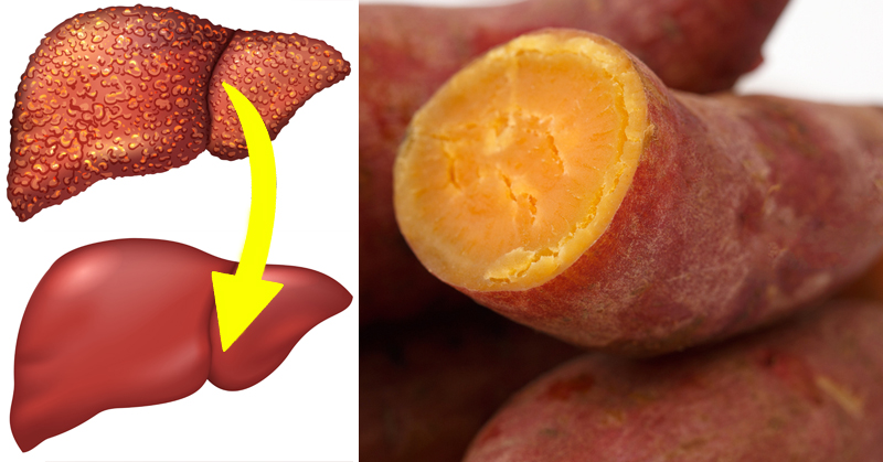 Bu Besinleri Tüketin Karaciğer Yağlanmasından Tümden Kurtulun