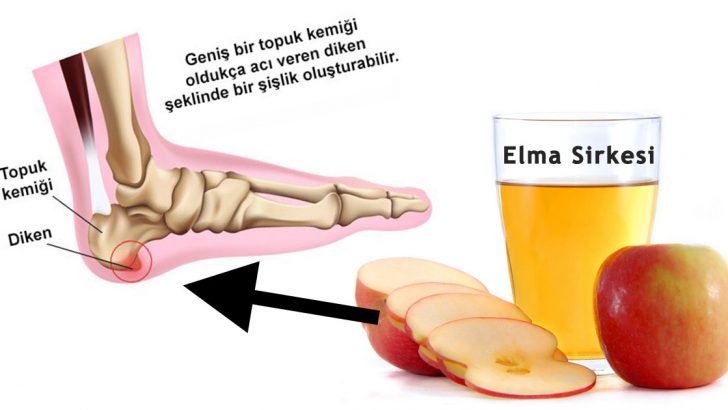 Evinizden Elma Sirkesi Eksik Olmasın