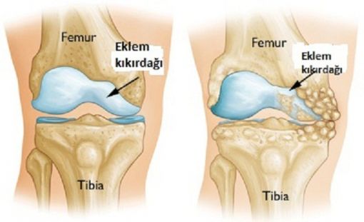Kireçlenme Sorununa Çözüm Olan Besinler ve Tedavisi İçin Öneriler