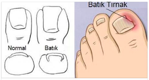 Tırnak Batması Tedavisi Aslında Bu Kadar Basitmiş