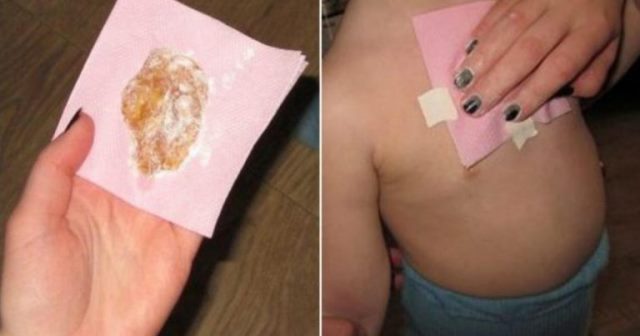 Öksürüğe Doğal Çözüm – Anında Rahatlayacaksınız