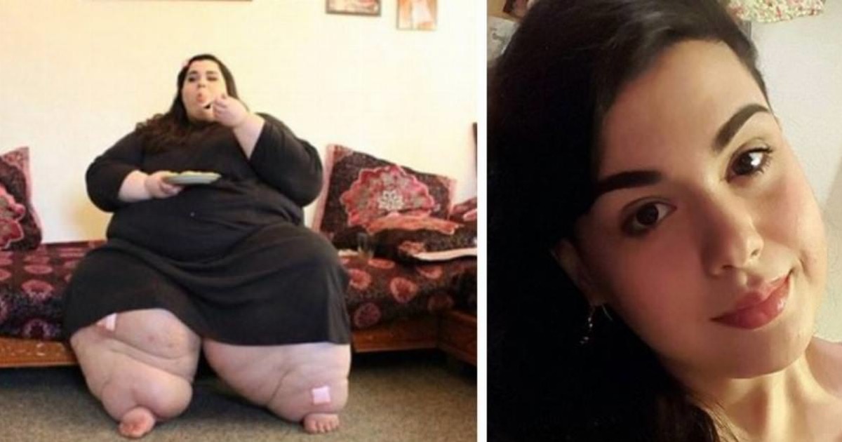 24 Yaşındayken 300 Kiloydu – 121 Kilo Verdikten Sonraki Haline İnanamayacaksınız