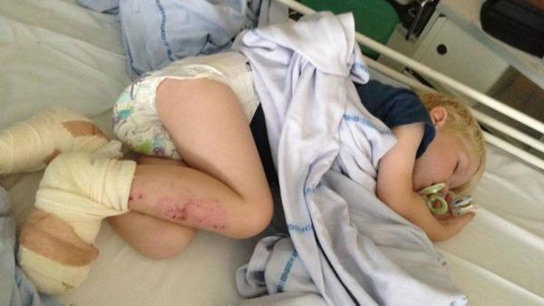 3 Yaşındaki Çocuk Plajda Oynarken Ayak Parmaklarını Kaybediyordu – Anne Şimdi Bütün Ebeveynleri Uyarıyor