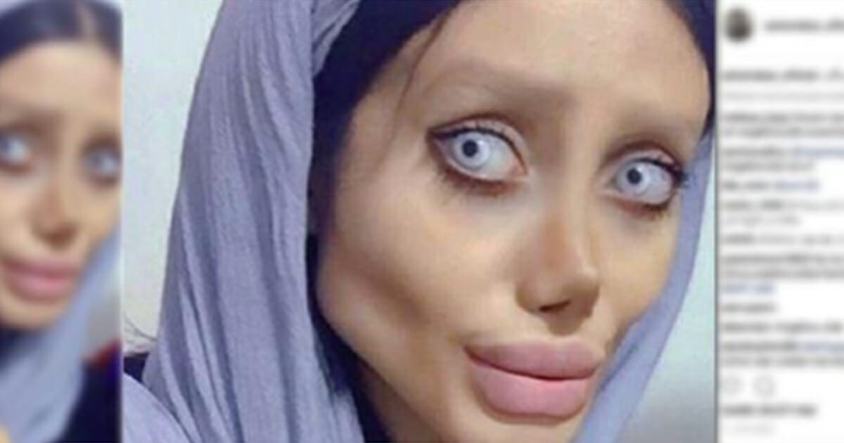 Angelina Jolie Gibi Görünmek İçin 50 Operasyon Geçirip 40 Kilo Verdi