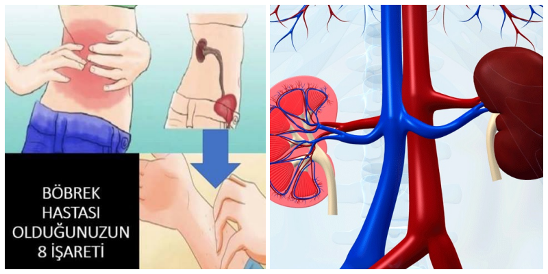Böbrek Hastalığınız Olduğunun 8 İşareti ?