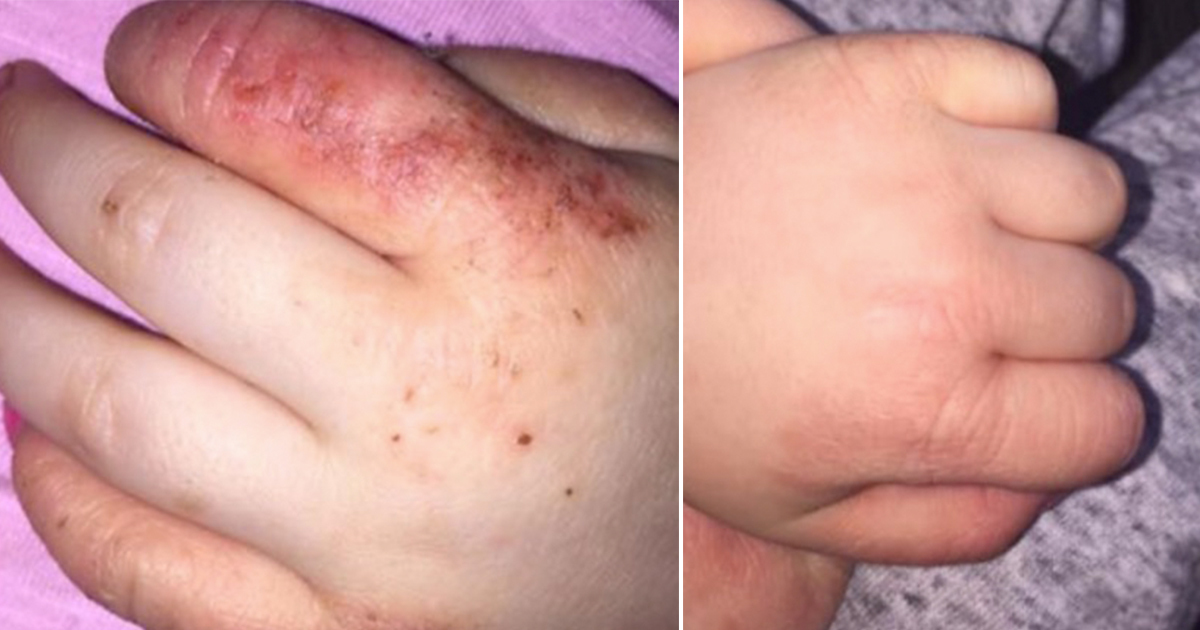 Egzama Hastası Kızı İçin Onlarca Dermatologa Gitti Ve Tonla Para Harcadı – Çareyi 5 Dolarlık Kremde Buldu
