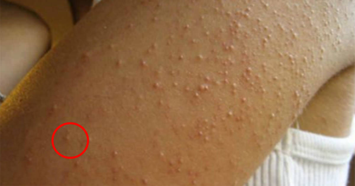 Gluten Duyarlılığınız Olduğunun 6 Net Belirtisi