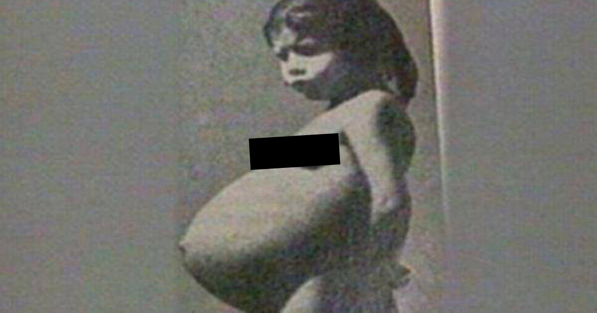 Herkes 5 Yaşındaki Kızda Tümör Var Sandı – Gerçek Açıklanınca İnsanlar Şok Oldu