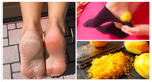 Nasırları Doğal Yollarla Yok Etmek Aslında Bu Kadar Basitmiş İşte Denenmiş Kürler