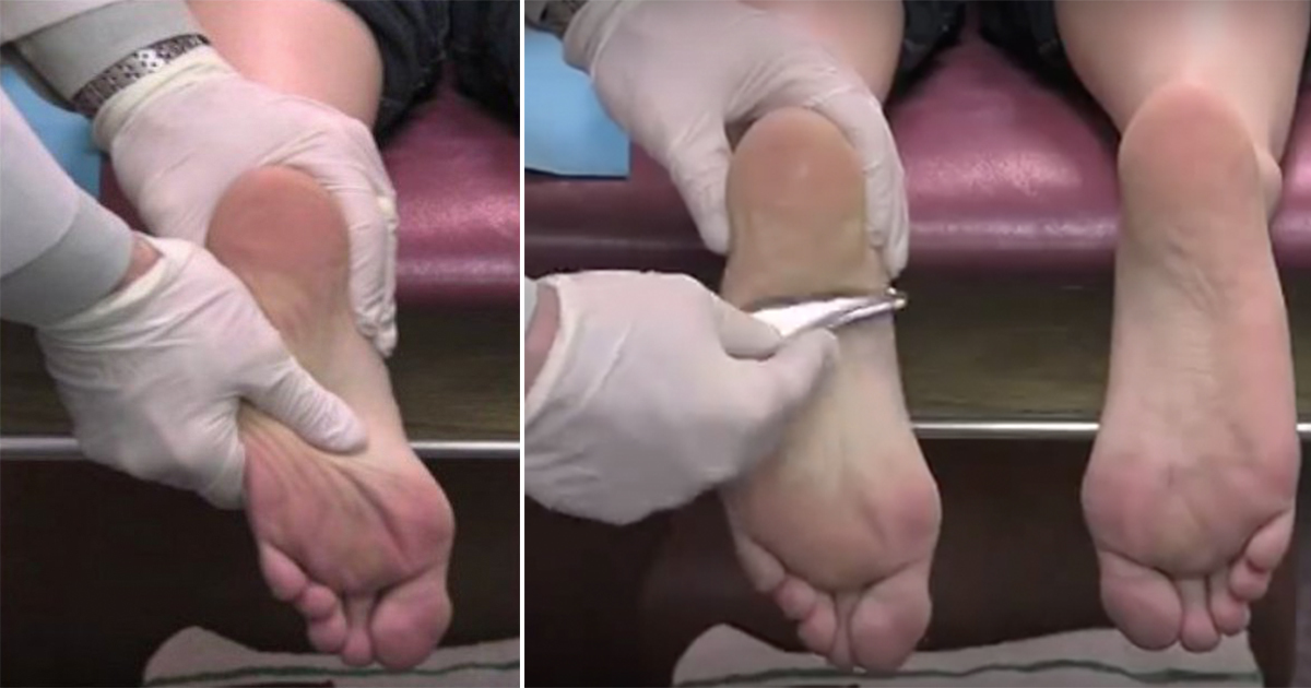 Topuğunda Sürekli Acı Hissediyordu – Bakın Doktor Acısını Hemen Nasıl Geçirdi