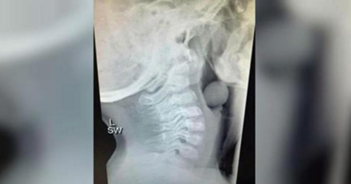 Çocuğunun Röntgenindekiler Anneyi Şaşırttı – Şimdi Bütün Ebeveynleri Uyarıyor