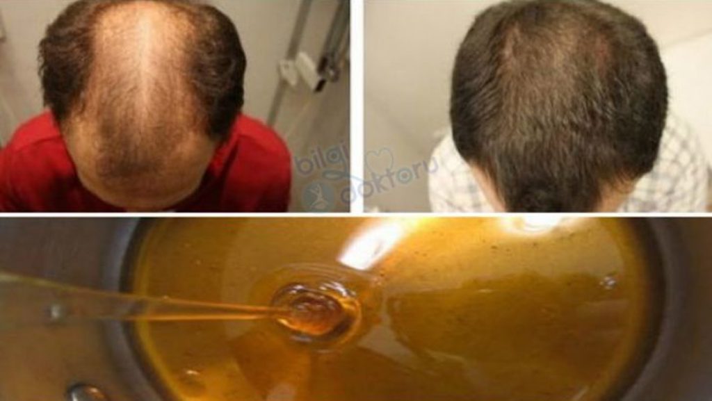 Bu yöntem ile 2 gün sonra saçlarınızın dökülmesi duracak =>>>