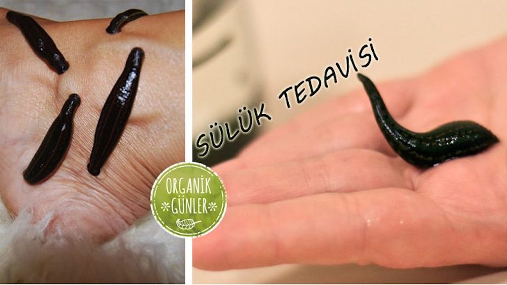 Sülük Tedavisi – Sülüklerin Faydaları HASTALIKLARA KARŞI SÜLÜK TEDAVİSİ NASIL YAPILIR?