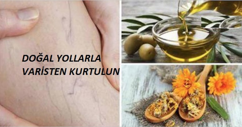 Zeytinyağı ve Kadife Çiçeği Tedavisi İle Varisten Kurtulun