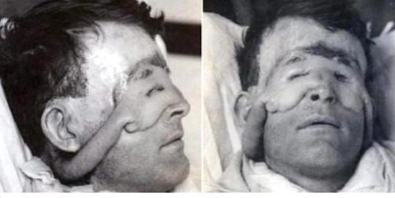 Tarihin ilk plastik cerrahi ameliyatı! Son hali inanılmaz..!