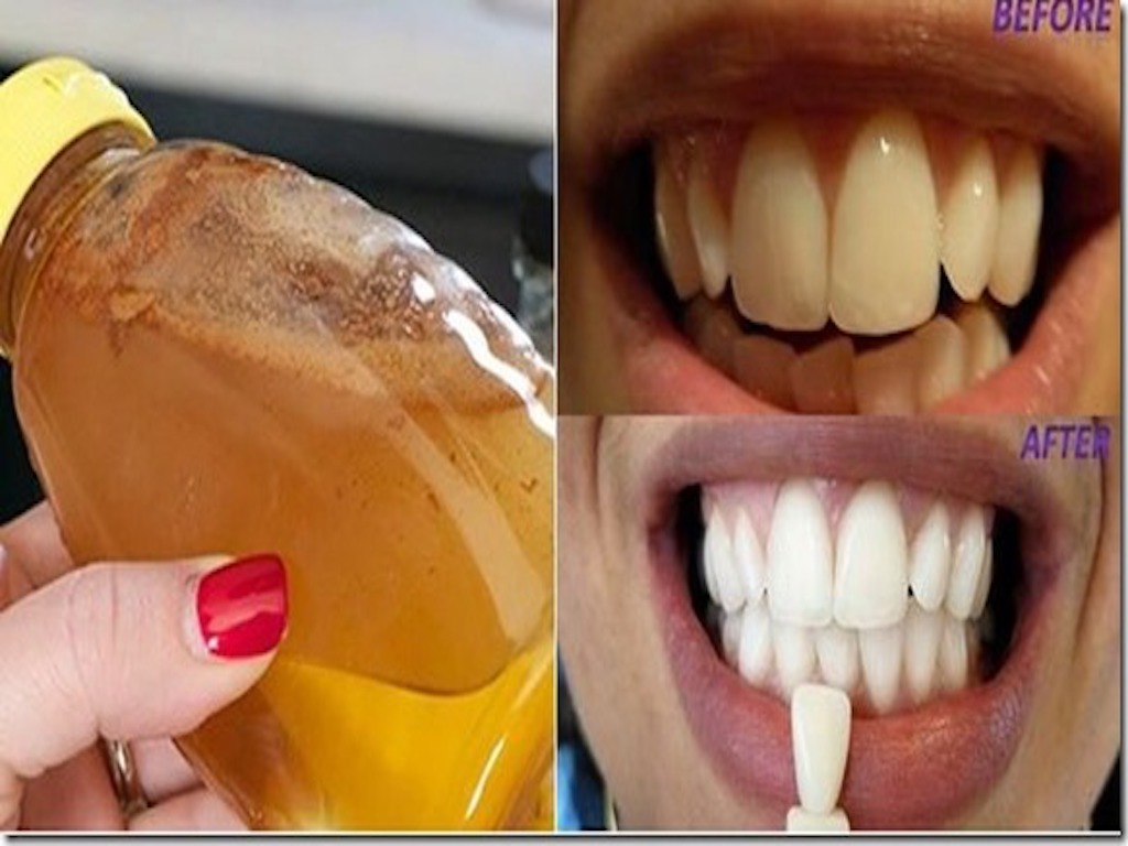 Evde Kendiniz Bu Doğal Yöntemle Dişlerinizi Bembeyaz Yapabilirsiniz Hem de Sadece Her Evde Bulunan 3 Malzeme ile