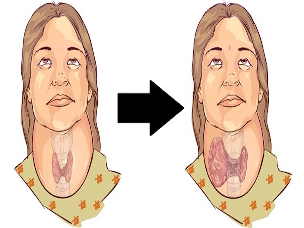 Tiroid’i Tetikleyen 5 Kötü Alışkanlık – Bu Alışkanlıklarınızdan Mutlaka Kurtulun
