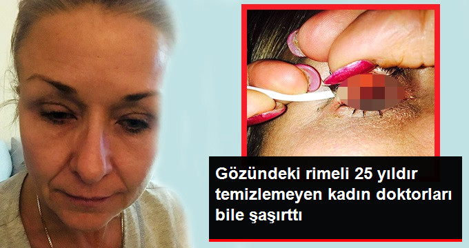 25 Yıl Boyunca Gözündeki Rimeli Temizlemeyen Kadının Hali Doktorları Bile Şaşkına Çevirdi