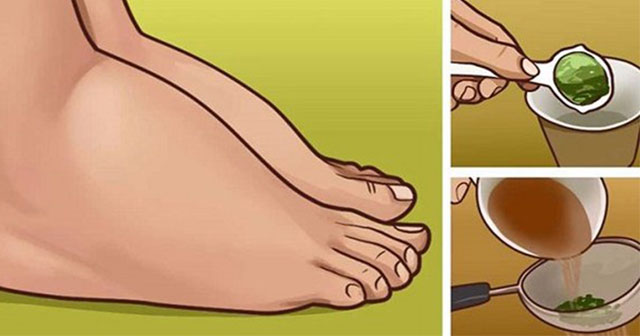 Şişmiş Ayak ve Ayak Bileğine Denenmiş 3 Doğal Çözüm