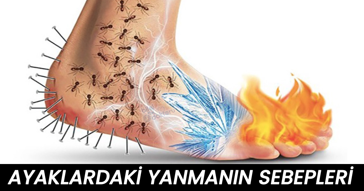 Ayaklarda Yanma Neden Olur – Ayak Yanması Sebepleri