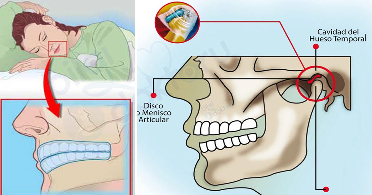 Uykuda Diş Gıcırdatma Belirtileri ve Tedavi Yöntemi
