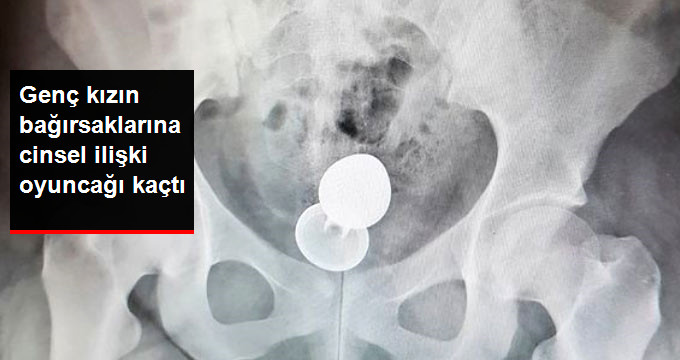 GENÇ KIZIN BAĞIRSAKLARINA CİNSEL İLİŞKİ OYUNCAĞI KAÇTI