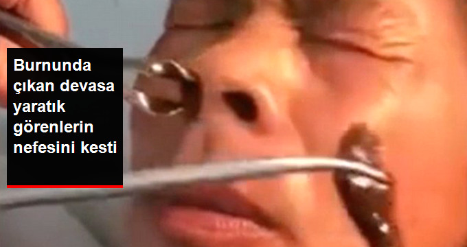 Çinli Adamın Burnundan Çıkan Devasa Sülük Görenleri Şaşırttı