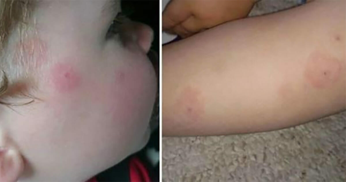 Oğlunun Vücudunda Tuhaf Kızarıklıklar Çıktı – Doktora Gitmese Oğlunu Kaybedecekti