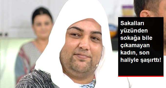 Sakalları Yüzünden Sokağa Dahi Çıkamayan Genç Kadın, Son Haliyle Şaşırttı